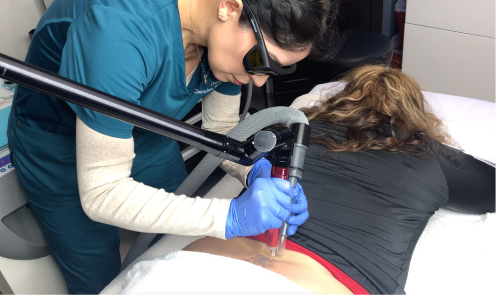 Houston Tattoo Removal Laser Tattoo Removal Houston