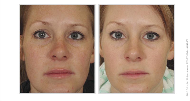 BBL Photofacial: The Big Difference with IPL – lumenessa