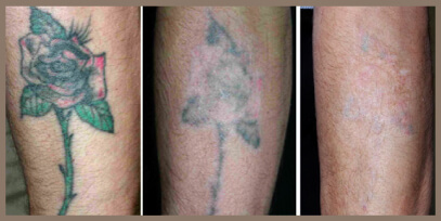 Tattoo Removal Techniques  The Vein Institute  MediSpa