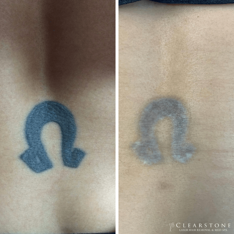 Laser Tattoo Removal  Image Enhancement Center