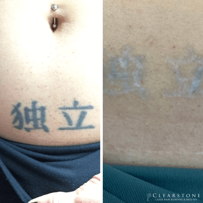 Laser Tattoo Removal Services Offered in Houston Texas